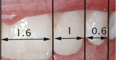 Diseño de Sonrisa