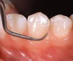 Periodoncia, el tratamiento adecuado para el sangrado de encias